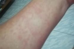 喝红酒大腿过敏红痒怎么办呢